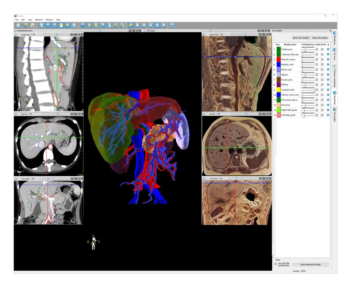 3D liver and blood vessels reconstruction